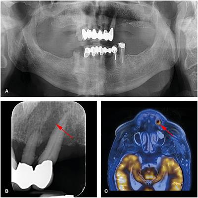 Value of FDG-PET/MR in Oral Focus Assessment in Head and Neck Cancer Patients—A Feasibility Study